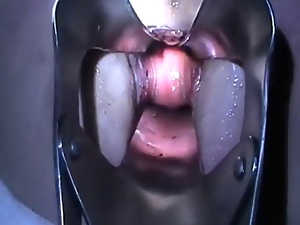 Monster Speculum Anal